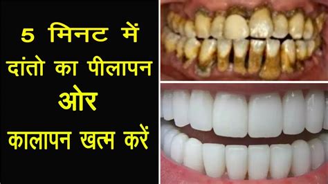 5 मिनट में दांतो का पीलापन और कालापन खत्म करे Teeth Whitening Tips In