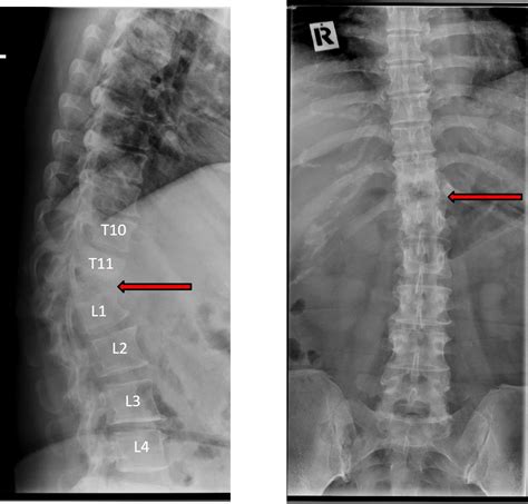 Vertebra plana – Radiology Cases