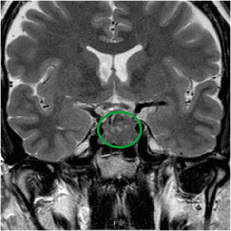 Brain MRI Pituitary Tumor