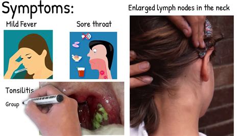 Infectious Mononucleosis Easy Explained YouTube