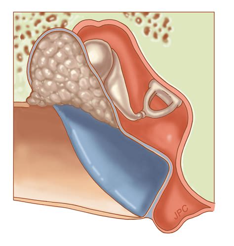 This Is A Drawing Of A Cholesteatoma A Tumor In The Ear It Can Eat