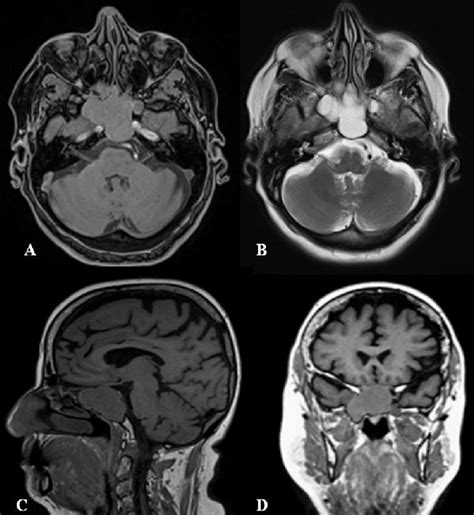 Sphenoid Sinus Tumours