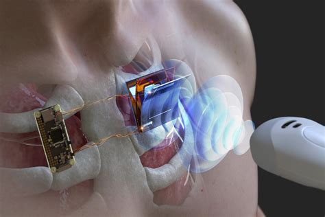 Implanted Generator Could Use Ultrasound To Charge Pacemaker Batteries