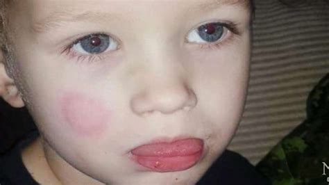 Petawawa Boy 4 Injured After Getting Tongue Stuck On School Bus