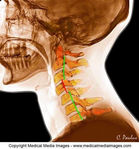 Cervical Spine Subluxation