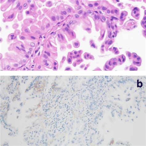 Histopathological Findings Of Tissue Specimens Obtained Under