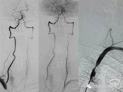 锁骨下动脉盗血综合征 脑医汇 神外资讯 神介资讯