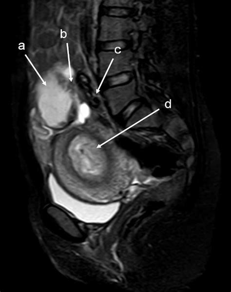 T2w Spair Sagittal Mri Of Lower Abdomen Demonstrating The Placental Download Scientific Diagram