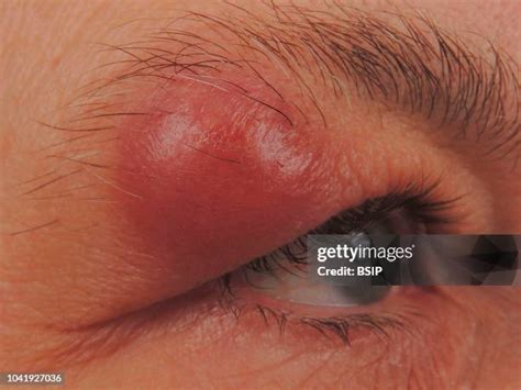 Sebaceous Cyst Photos Et Images De Collection Getty Images