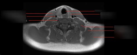 Axial Mri Neck Diagram Quizlet