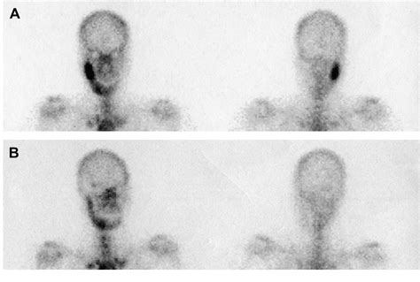 Figure 1 From Initial Results Of The Treatment Of Diffuse Sclerosing Osteomyelitis Of The