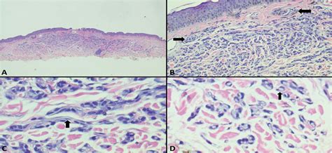 melanocytic nevus  elastophilic features  american journal