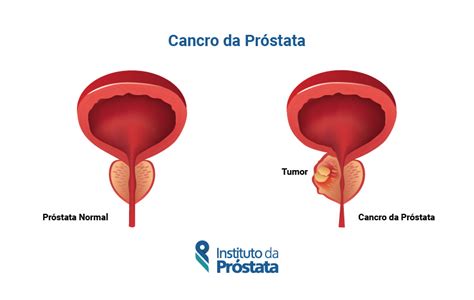 Função Da Prostata Masculina - Qual é a função da Próstata na saúde do Homem?