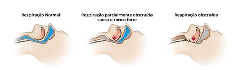 Apneia Obstrutiva Do Sono AOS Otosons