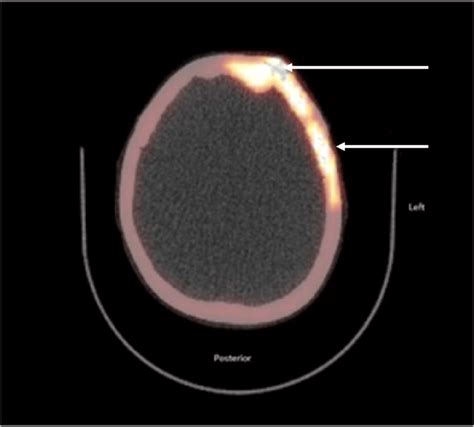 Axial Fused Fnaf Pet Ct Bone Scan Of Previous Case From Figure