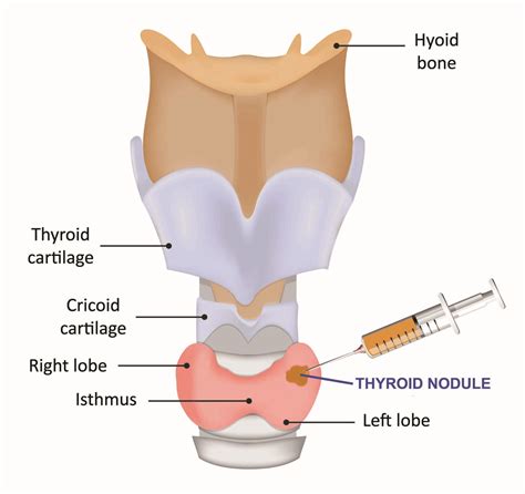 Thyroid Nodules Dr Meei Yeung