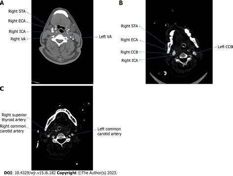 Computed Tomography Angiographic Study Of Surgical Anatomy Of Thyroid