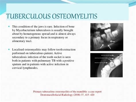 Osteomyelitis