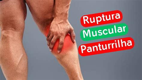 Ruptura Muscular Panturrilha Dr Prof Nelson Marques Youtube