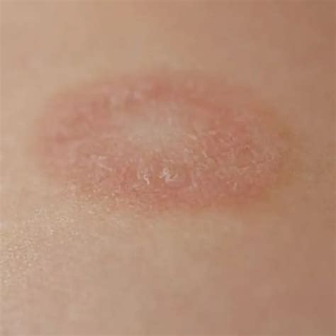 Pityriasis Rosea Dermatology Located In Fairfax Va Integrated