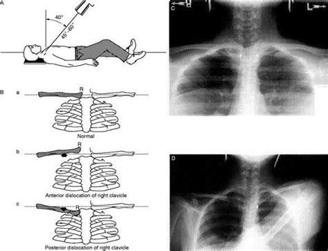 Sternoclavicular Joint Dislocation — Kwak Talk