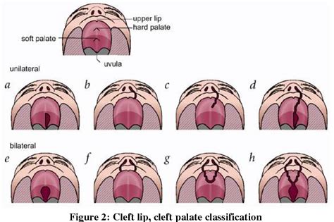 Cleft Palate Types