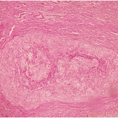 Histopathology Slide Of Resected Mass Showing Multiple Granulomas With Download Scientific