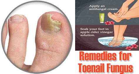 15 Diy Home Remedies For Toenail Fungus