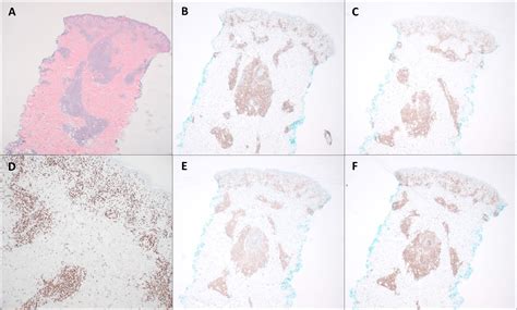 Fip1l1pdgfra Fusion Driving Three Synchronous Haematological