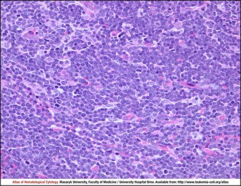 T Lymphoblastic Leukaemia Lymphoma Cell Atlas Of Haematological