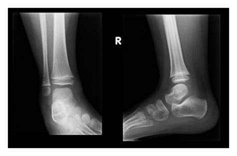 Ap And Lateral X Ray Of The 4 Year Old Patient With Normal Findings