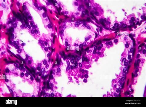 Hyperplasie B Nigne De La Prostate Micrographe L Ger Photo Sous