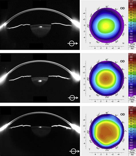 Reliability Of Pentacam HR Thickness Maps Of The Entire Cornea In