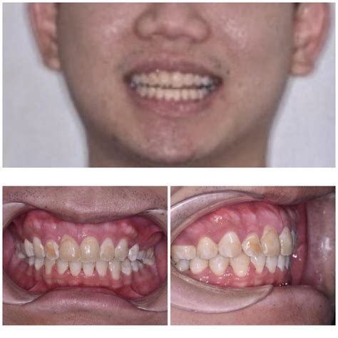 Just completed my braces treatment. : r/braces