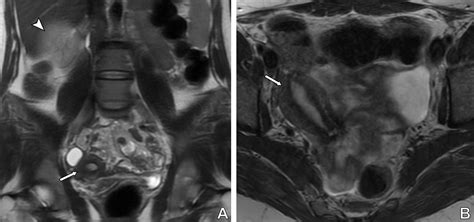 Müllerian Duct Anomalies Role In Fertility And Pregnancy Radiographics