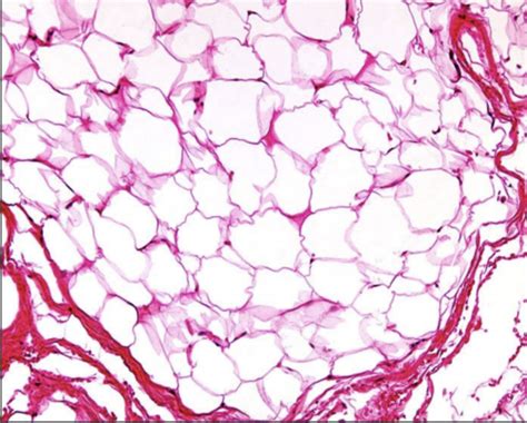 Msk Unit Pathology Images Flashcards Quizlet