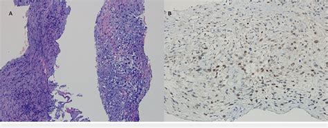 Malignant Mesenchymal Neoplasm Composed Of Spindleshaped And