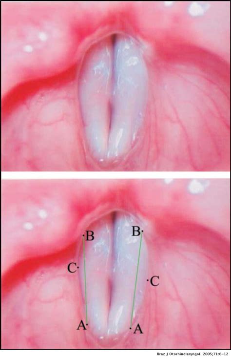 Vestibular fold configuration during phonation in adults with and without dysphonia | Brazilian ...