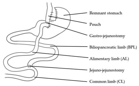 Roux En Y Gastric Bypass Afferent Limb