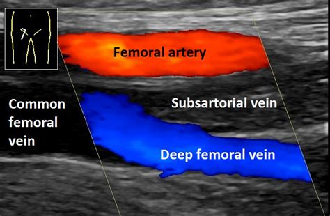 Deep vein thrombosis - Wikiwand