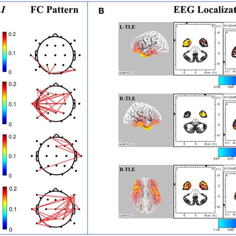 FIGURE E Diagrams Of The Functional Network In Patients With TLE And