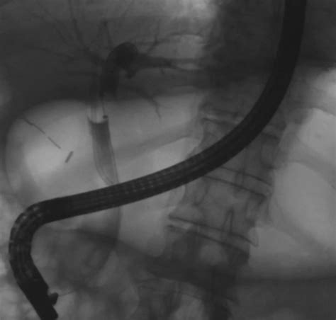 Initial Cholangiogram From The Outside Hospital Demonstrating Proximal Download Scientific