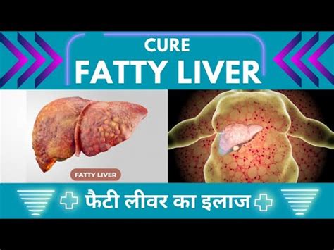 Heal Fatty Liver With Acupressure Su Jok Therapy