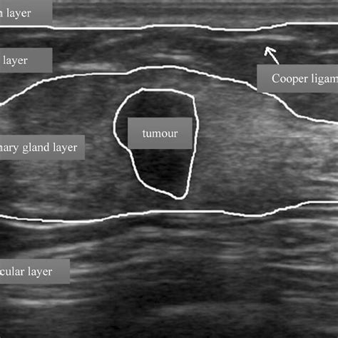 Experimental Sample Of A Breast Ultrasound Image Download Scientific