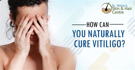 How Can You Naturally Cure Vitiligo?