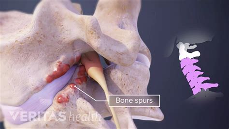 Bone Spurs Osteophytes And Back Pain Spine Health