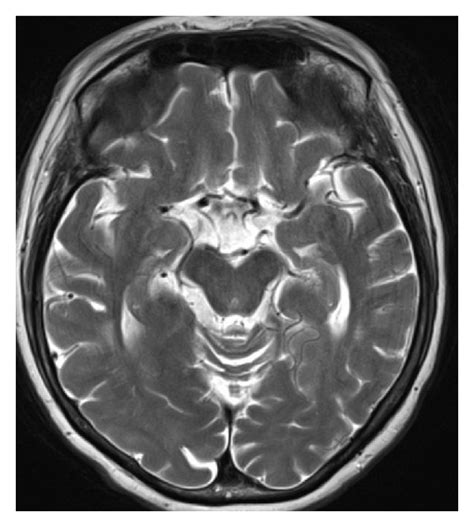 A And B T2 Tse Images Showing Multifocal Areas Of White Matter T2