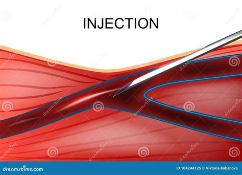 The Intravenous Injection of Drugs Stock Vector - Illustration of fluid ...