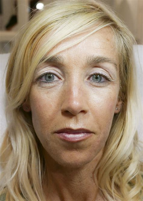 Wallen en donkere, diepe kringen onder ogen verwijderen zonder Botox