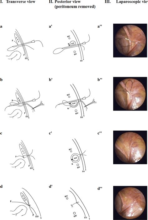 The Procedure Of Percutaneous Internal Ring Suture For Female Indirect